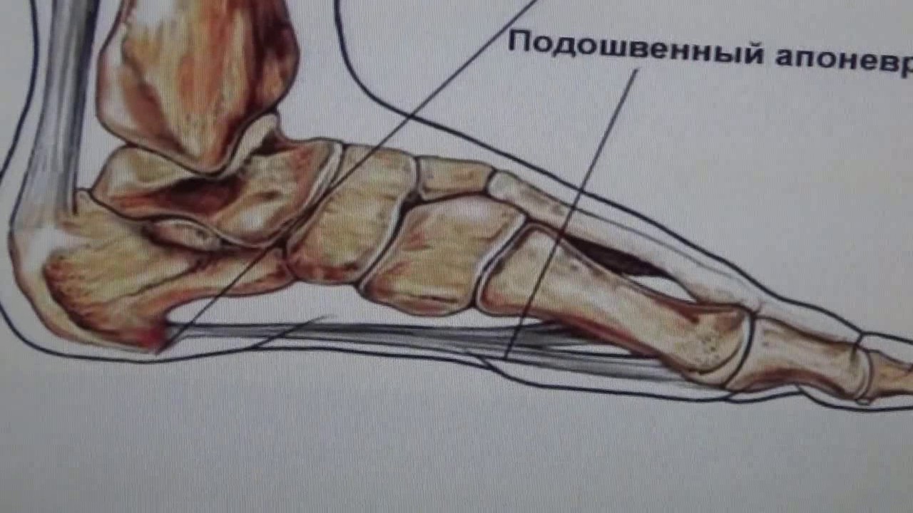 Как самому вылечить пяточную шпору, самый эффективный метод!!!