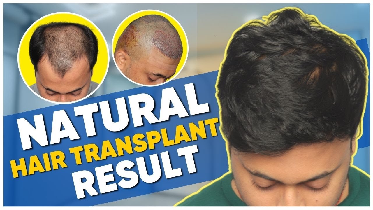 Hair Transplant in Thailand Best Results & Cost of Hair Transplant in