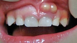 الخراج السني Dental abscess  |الاسباب الاعراض العلاج |