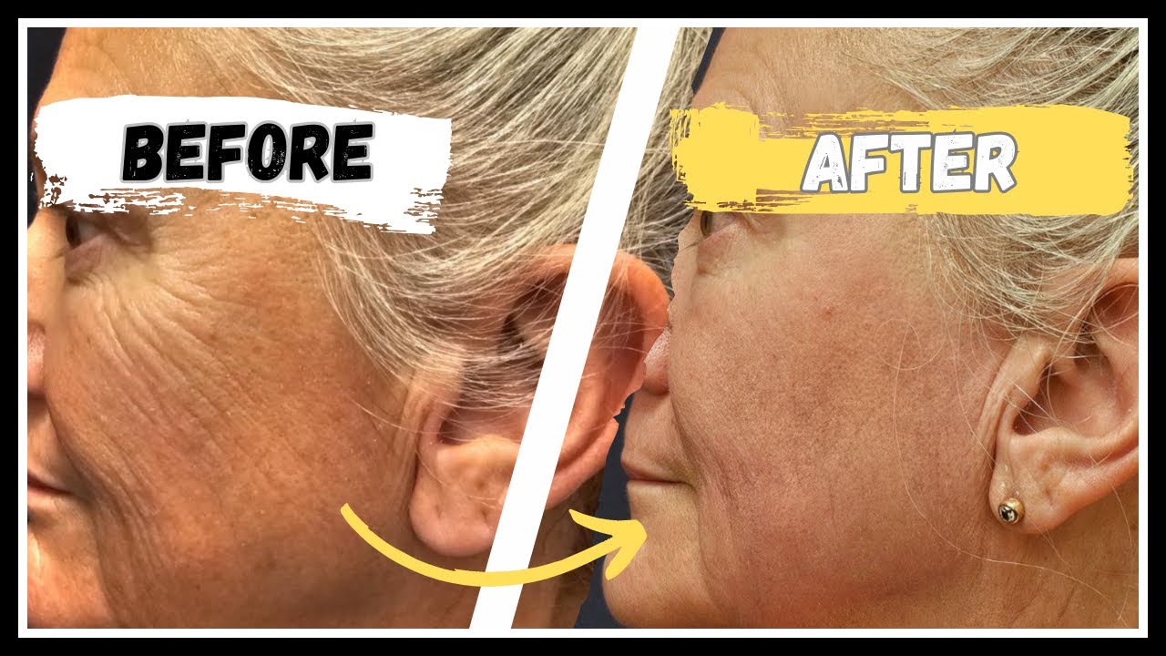 Stunning RESULTS in ONE treatment! Over 40, 50, 60, 70+ rejuvenation?! YES!!