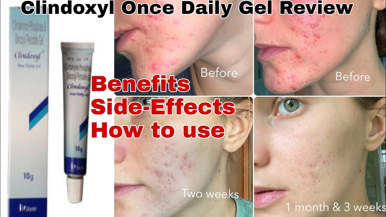 clindoxyl cream