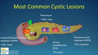 Natural History of Pancreatic Cysts: What Becomes of Them?