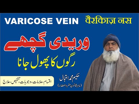 Varicose Vein ► ویریکوس رگوں کا پھول جانا ► वैरिकाज़ नस ► Hakim Muahmmad Iqbal Al Huda Guidance