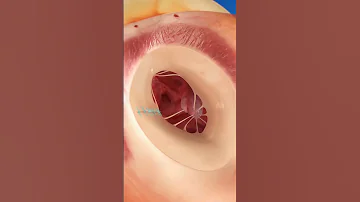 كيف يتم إصلاح الصمام التاجي 