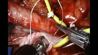 Single-Port Robotic-Assisted Extraperitoneal Kidney Transplantation (Graphic) screenshot 4