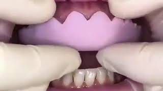 مدل های مختلفت لمینیت دندان | نحوه لمینیت کردن دندان | مراحل لمینیت کامپوزیتی | روکش دندان چیست