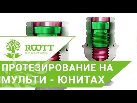 👌 Импланты с мульти—юнитами ROOTT. Протезирование на мультиюнитах