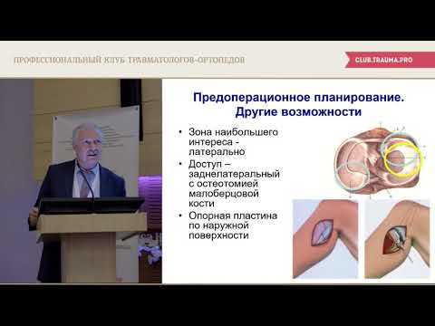 Переломы проксимального отдела большеберцовой кости