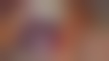 Bilateral Minithoracotomies for Combined Coronary Bypass Grafting and Mitral Valve Repair