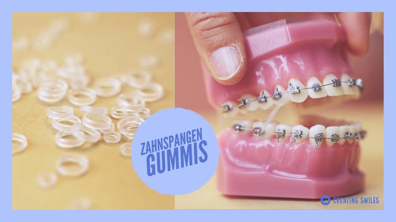 Wann Bekommt Man Gummis Für Die Zahnspange