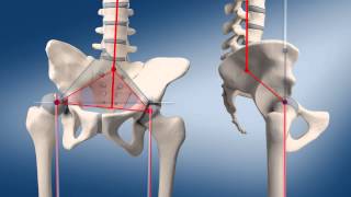 Custom made total hip replacement | Medical Animation