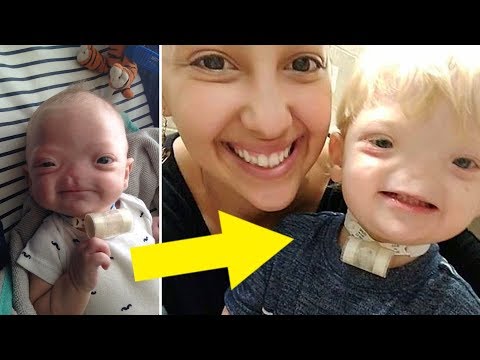 Video: A Two-year-old Boy Died In The USA, Who Was Born Without A Nose - Alternative View