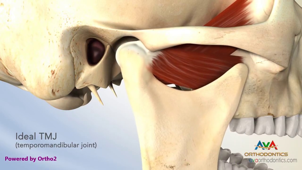 TMJ Disorder or TMD   Clicking and Closed Lock