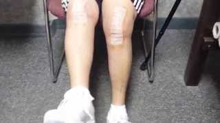 Bilateral Knee Replacements  by Dr Lupo at 2 Weeks.