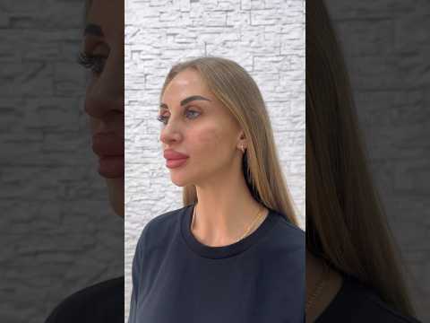 Скулы для прекрасной девушки. Точеные линии #косметологростов #контурнаяпластика #красотаиздоровье