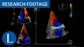 3D volume rendering of the mitral valve obtained with transoesophageal echocardiography