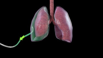 Treatment of Pneumothorax