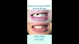 牙桥 / 齿桥的制作过程 l 牙科诊所