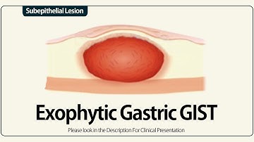 Linear EUS : Exophytic Gastric GIST