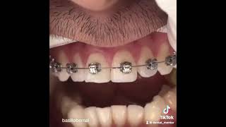 Self ligation bracket #ortho