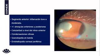 Uveítis Intermedias Pars Planitis