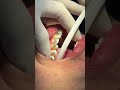 BRACE #shorts #teeth #brace