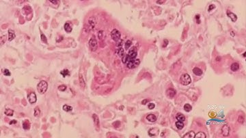 New Record Number Of Measles