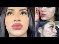 Full-Coverage Acne Makeup-Tutorial!TIPS YOU NEED TO KNOW!