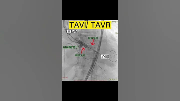 TAVI/TAVR 主动脉瓣膜导管置换_心衰竭治疗 - 天天要闻