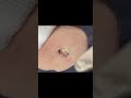 A coconutcream cyst on the chest 