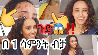 ፊት ላይ ለወጣ ነገር ሁሉ በ 1 ሳምንት ፏ የሚያረግ ተመልከቱ