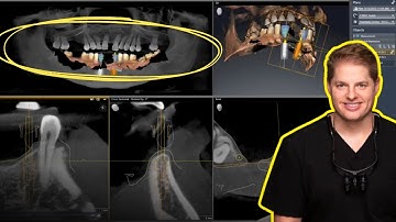 From Partial Dentures to Permanent Smiles: A Digital Implant Case Study