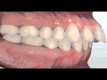 Deep Bite - Dr. Matthew David McNutt, Orthodontist