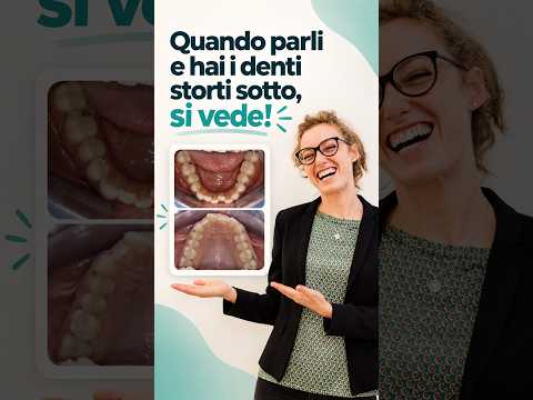 Quando parli si vedono i denti sotto: perché anch'io ho allineato l'arcata inferiore