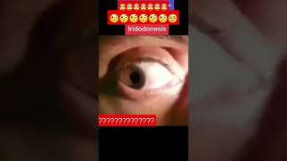 Iridodonesis is a condition in which the iris vibrates during eye movements #trending #eye #iris