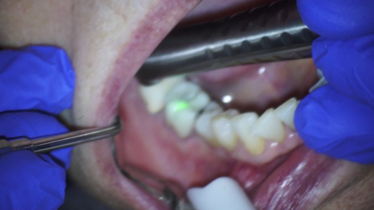 Fotona Erbium Laser Zirconia or Porcelain Crown Removal YouTube