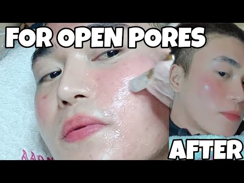 Video: 3 Mga Paraan upang Makakuha ng Collagen Induction Therapy