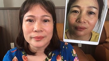 Cận Cảnh Nếp Mí Sau Khi Cắt Mí Mani Open Deep 5D.