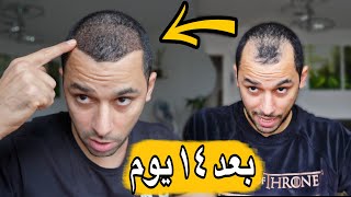 HOW MUCH $ دفعت كام في زراعة شعري في تركيا