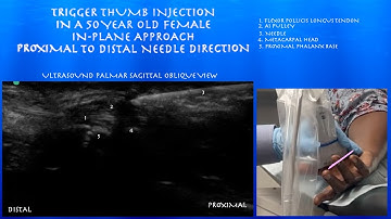 Ultrasound Guided Trigger Thumb Injection in a 50 year Old Female by probeultrasound.com
