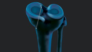 Medial Meniscus Root Repair Using the SutureLoc™ Implant