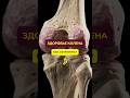 СЕКРЕТ ЗДОРОВЬЯ КОЛЕНЕЙ #колено #спортивнаямедицина #больвколене #упражнениядляколена