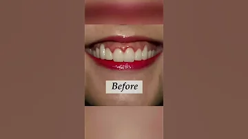 Gummy Smile No More DrRFD Shorts 