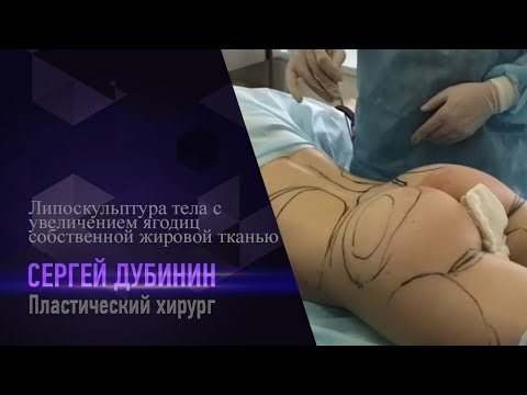 Липоскульптура тела с увеличением ягодиц собственной жировой тканью