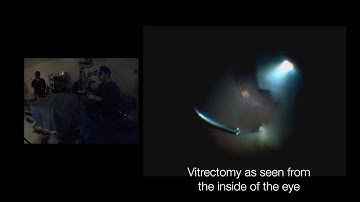 Vitrectomy As Seen From The Outside | Retina Center Tijuana | Dr. Aureliano Moreno