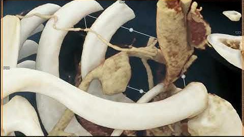 Right Subclavian Artery Aneurysm with Cinematic Rendering