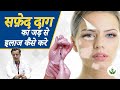 सफेद दाग 👨🏼‍⚕️ का जड़ से इलाज करे (Treat White Spot "Vitiligo" From Root) | Care Well Medical Centre