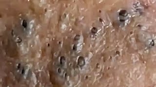 Blackheads & Whiteheads Satisfying Removal @0089