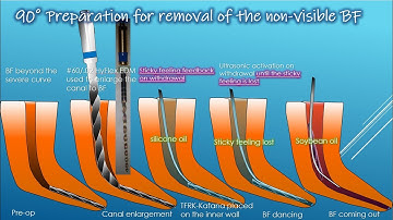 Removal of a partially nonvisible broken file using 90-degree preparation/90°形成法により部分的に見えない破折器具の除去