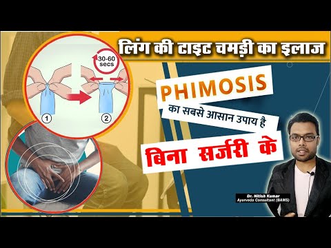 Phimosis Treatment | Phimosis treatment without Circumcision | Kumar’s Ayurvedic Gyan